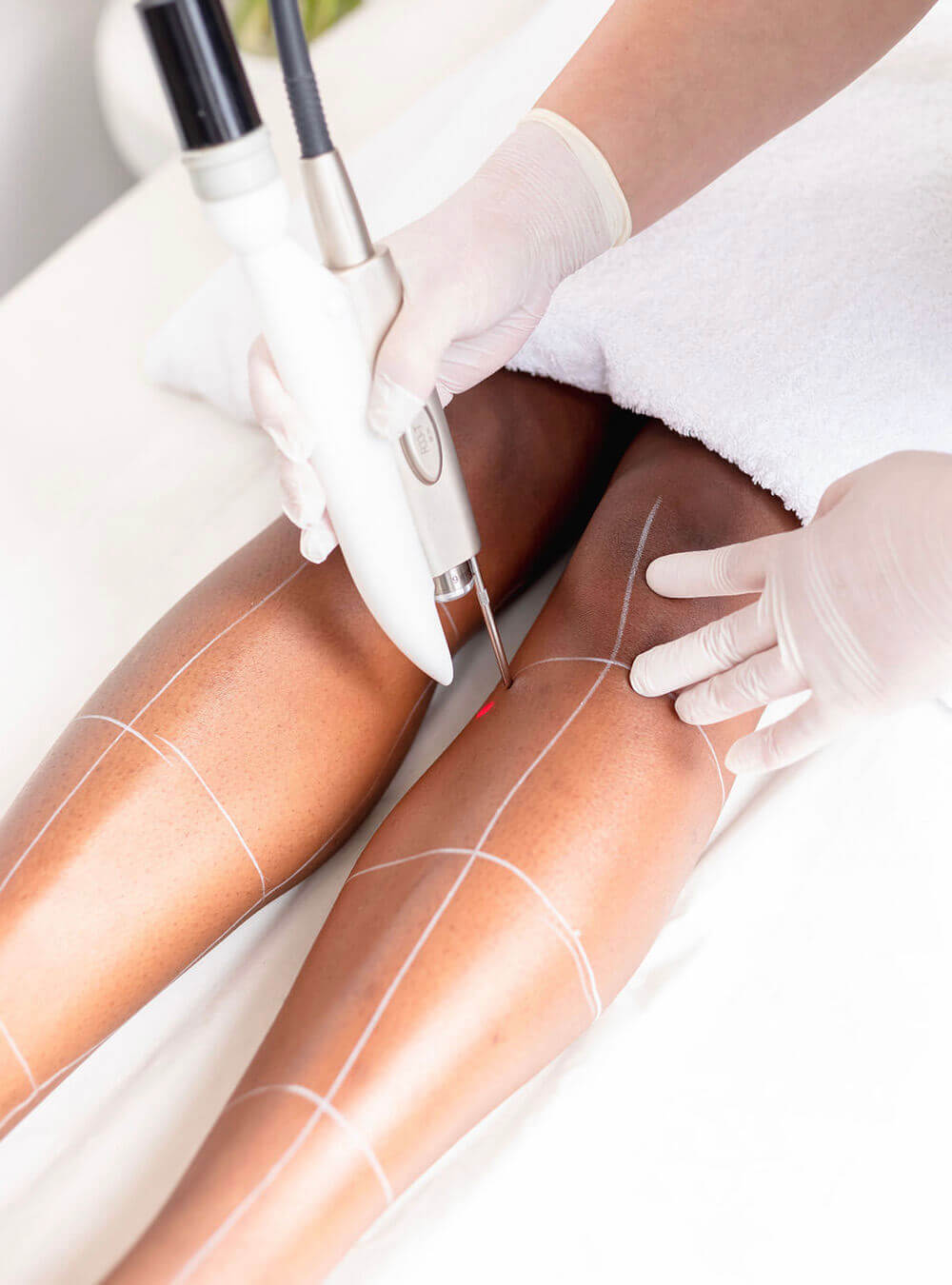 Female legs at Advanced Electrolysis treatment