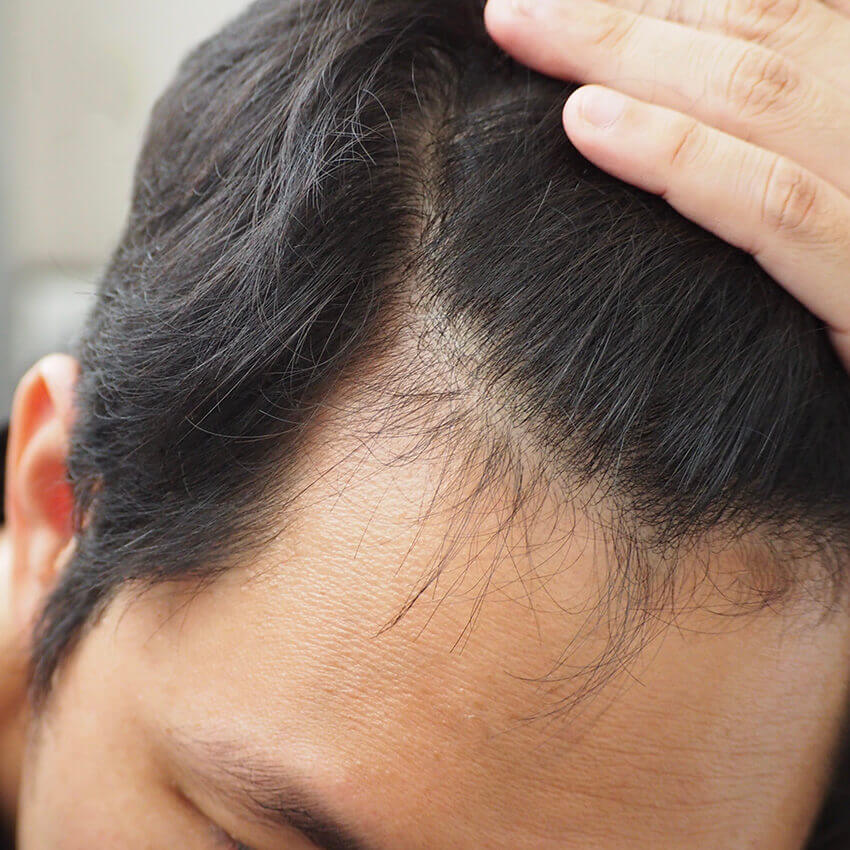 Patient head, Hair Loss Treatment Explained