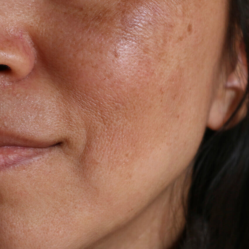 Melasma Treatment (female face)