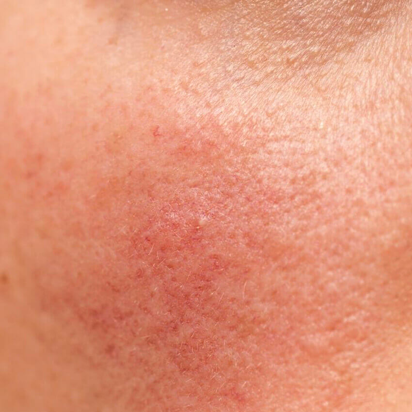 Rosacea Treatment (skin of face)