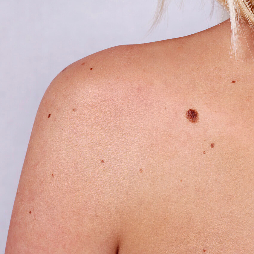 Scarless Mole Reduction Treatment (body skin)