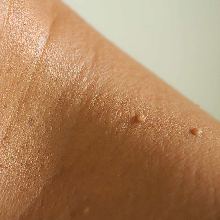Skin Tag Removal Treatment (skin)