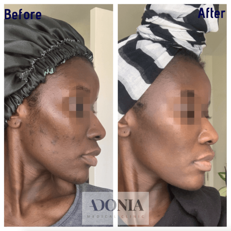 Female face, before and after Acne treatment, side view, patient 1