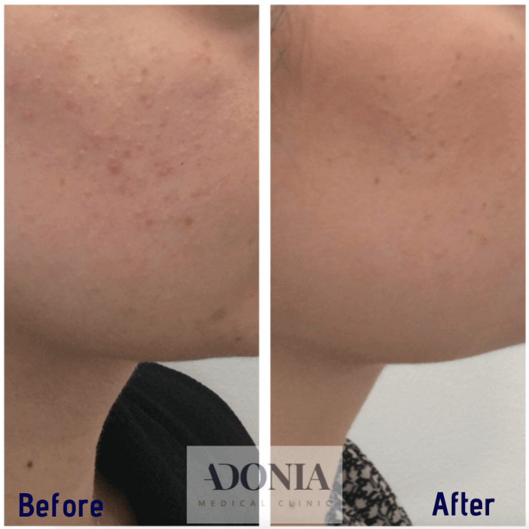 Female face, before and after Acne treatment, cheek - side view, patient 2