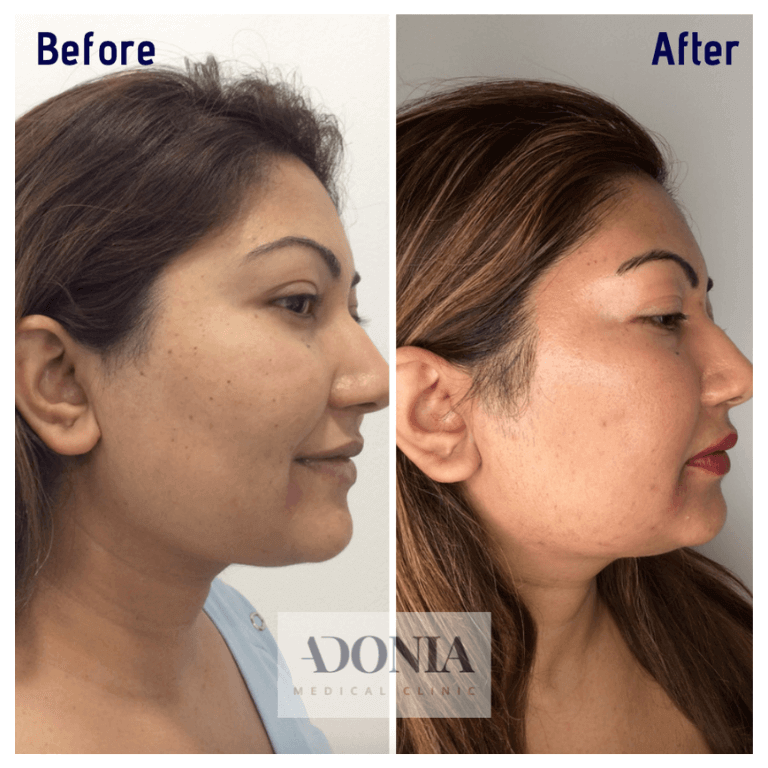 Female face, before and after Advanced electrolysis treatment, side view, patient 8