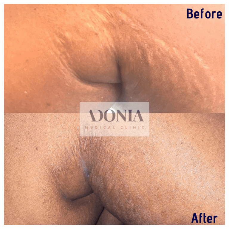 Before and after Stretch Marks treatment, front view, patient 27