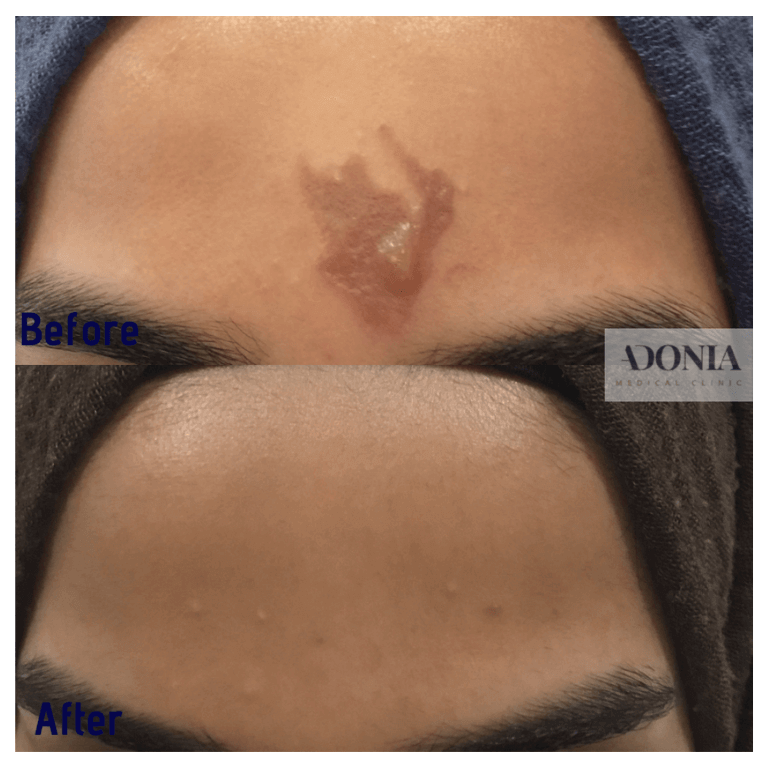Woman's forehead, before and after Burn Treatment, front view, patient 28
