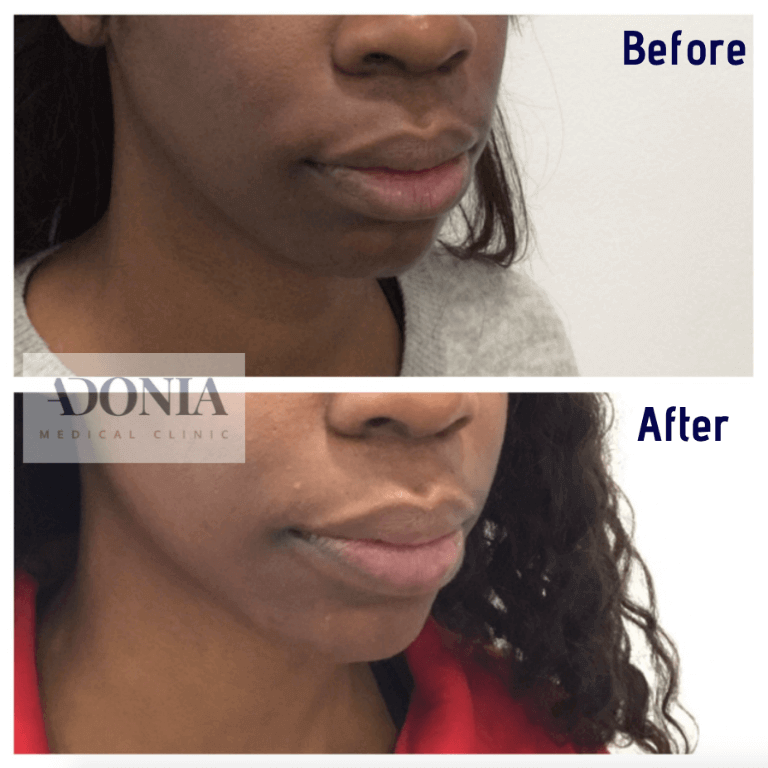 Woman's face, before and after Chin enhancement treatment, oblique view, patient 19