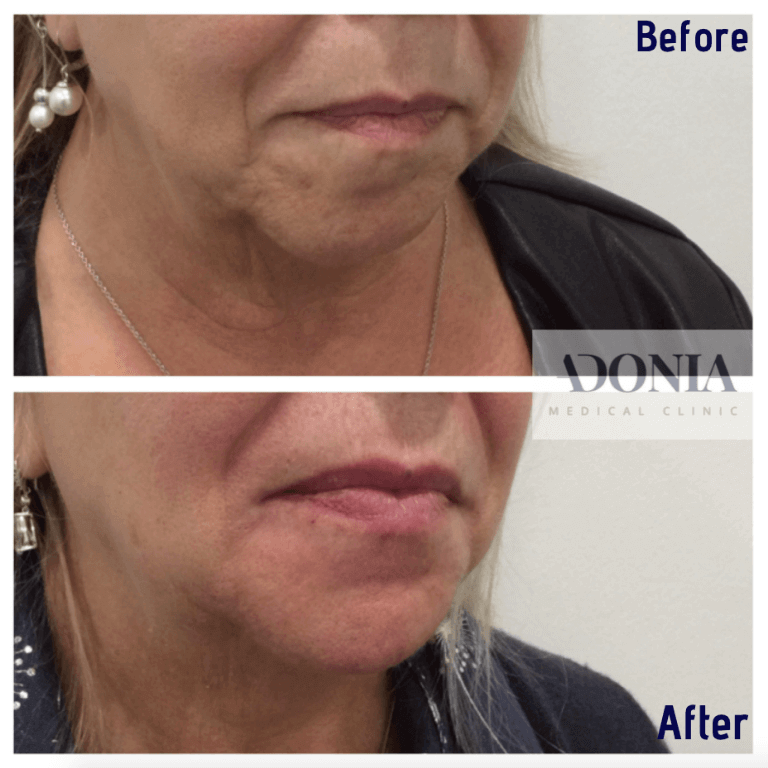 Woman's face, before and after Chin enhancement treatment, oblique view, patient 20