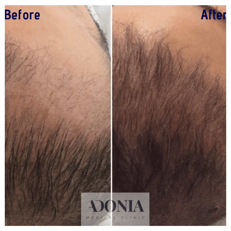 Head of male, before and after Hair loss treatment, patient 29