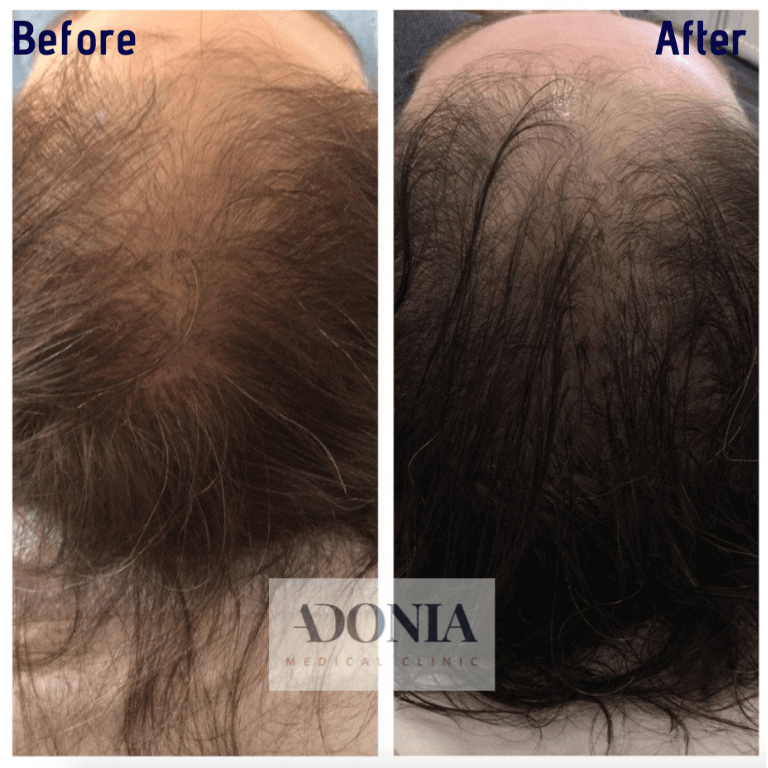 Head of female, before and after Hair loss treatment, patient 30