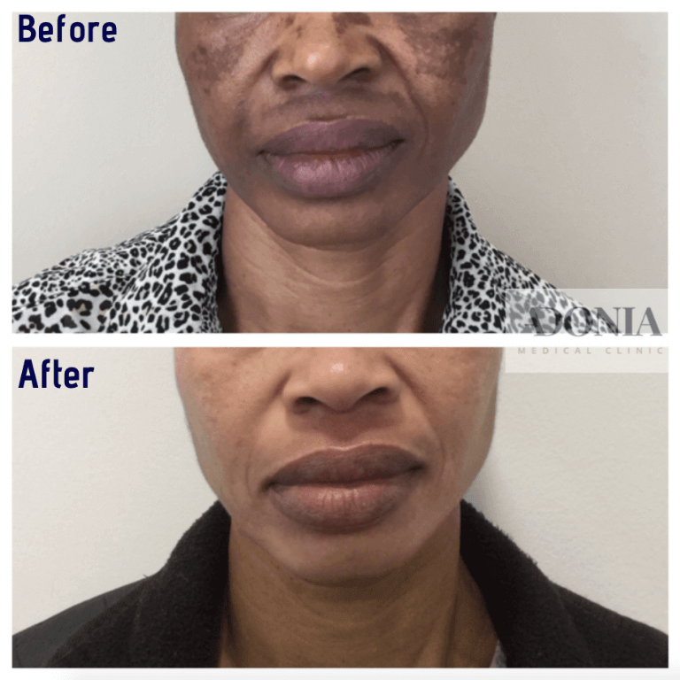 Female face, before and after Hyperpigmentation treatment, front view, patient 3