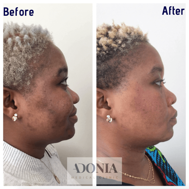 Female face, before and after Hyperpigmentation treatment, side view, patient 4