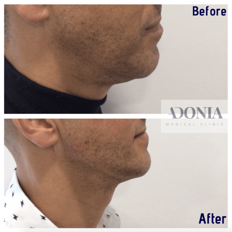 Male face, before and after Jawline enhancement treatment, side view, patient 21