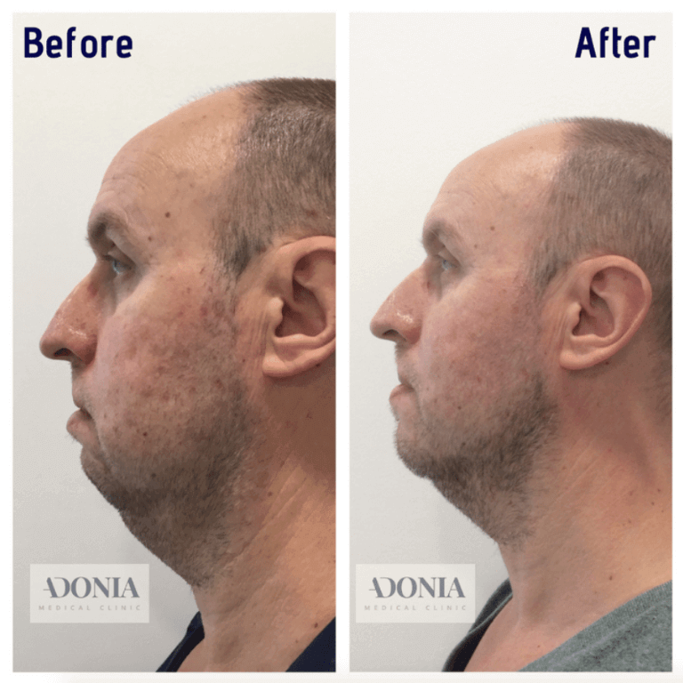 Male face, before and after Jawline enhancement treatment, side view, patient 22