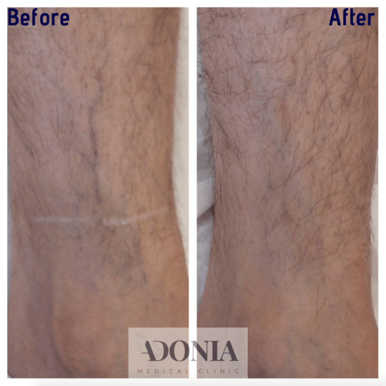 Male Legs, before and after Leg thread veins treatment, front view, patient 25