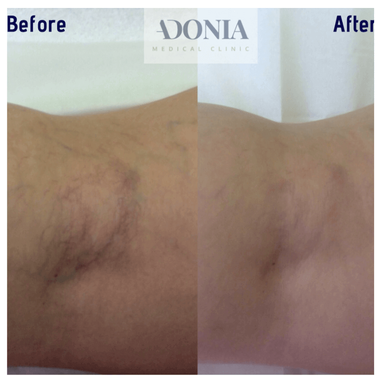 Patient veins, before and after Leg thread veins treatment, front view, patient 26