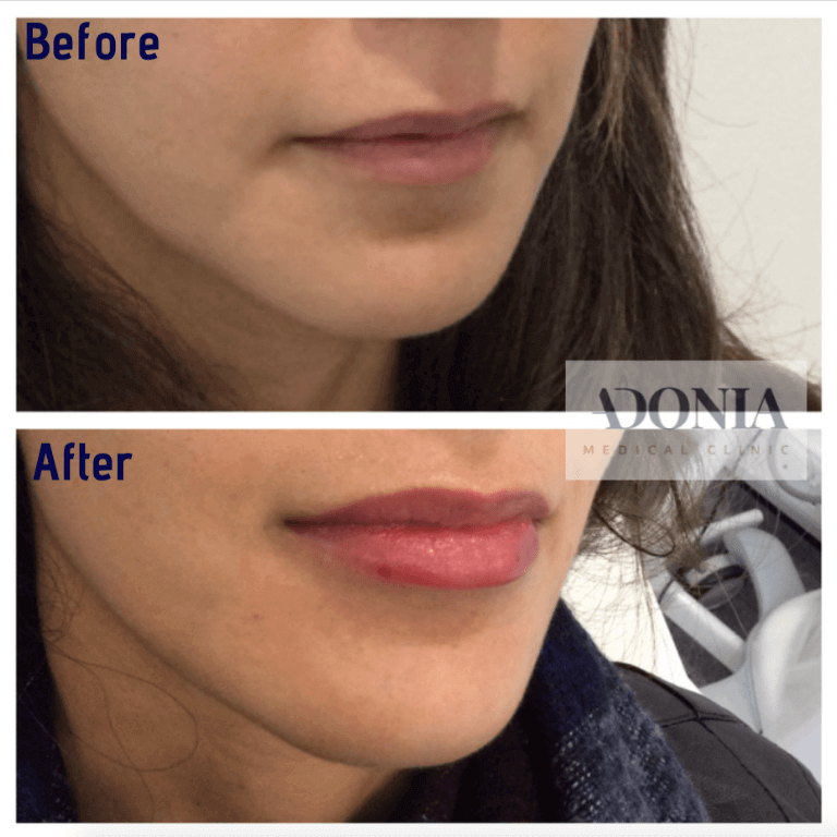 Woman's lips, before and after Lip enhancement treatment, oblique view, patient 13