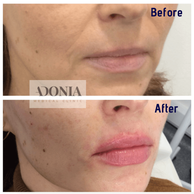 Woman's lips, before and after Lip enhancement treatment, oblique view, patient 14