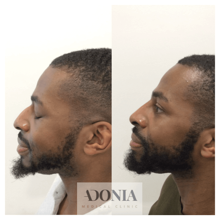 Male face, before and after Non-surgical nose job treatment, side view, patient 15