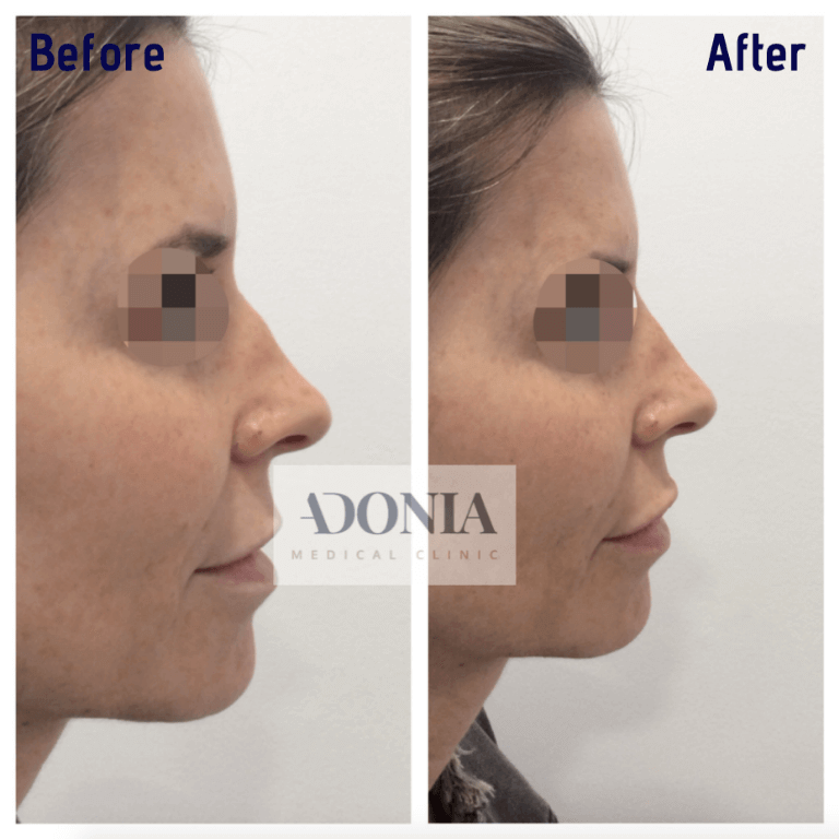 Woman's face, before and after Non-surgical nose job treatment, side view, patient 16