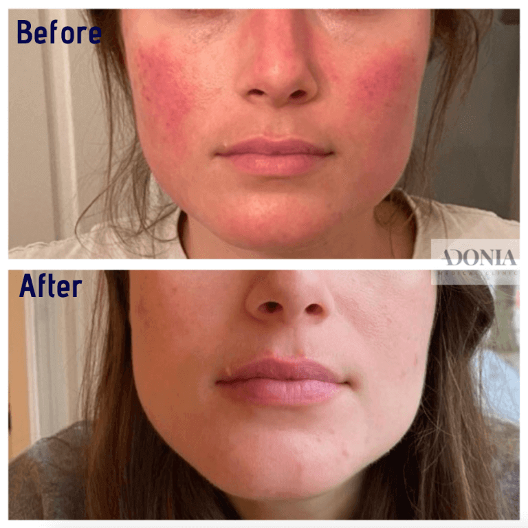 Female face, before and after Rosacea treatment, front view, patient 5