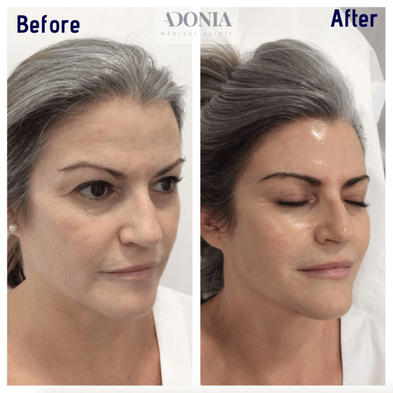 Female face, before and after Skin rejuvenation treatment, oblique view, patient 6