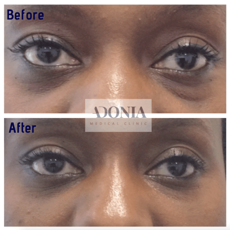 Woman's face, before and after Tear trough treatment, front view, patient 23