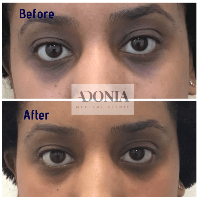 Woman's face, before and after Tear trough treatment, front view, patient 24
