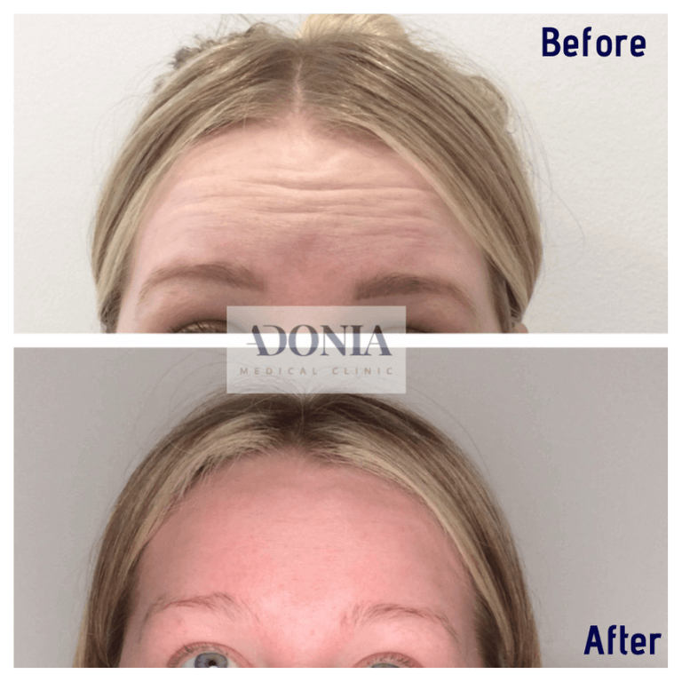 Woman's forehead, before and after Wrinkle relaxers, front view, patient 17