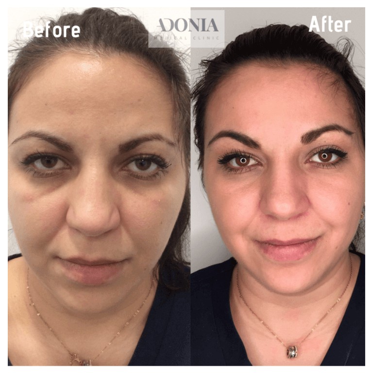 Woman's face, before and after Wrinkle relaxers, front view, patient 18