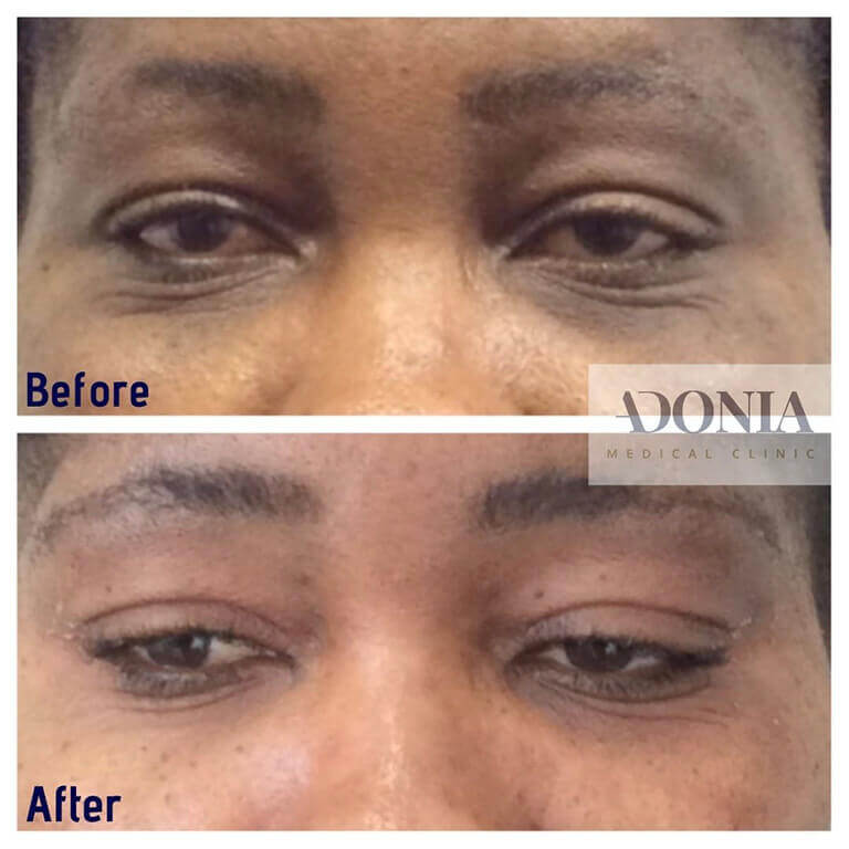 Woman's face, before and after Dark circles treatment, eyes - front view, patient 11