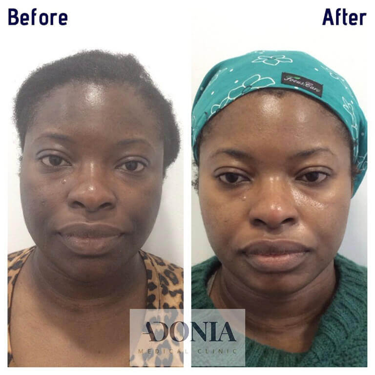 Woman's face, before and after Hyperpigmetnation treatment, front view, patient 12