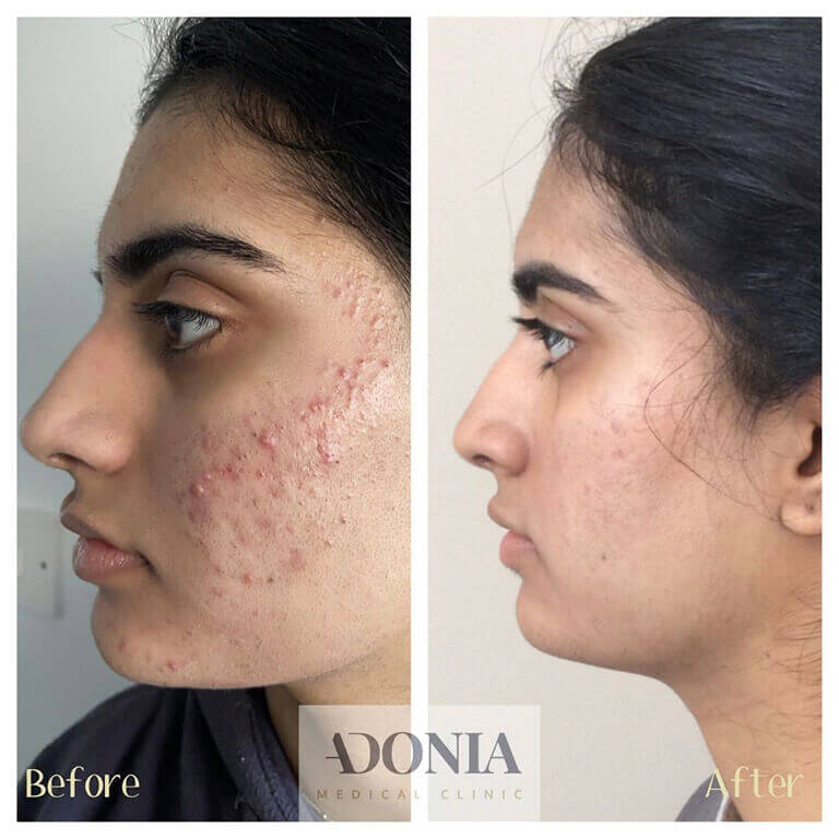 Woman's face, before and after Acne treatment, side view, patient 10