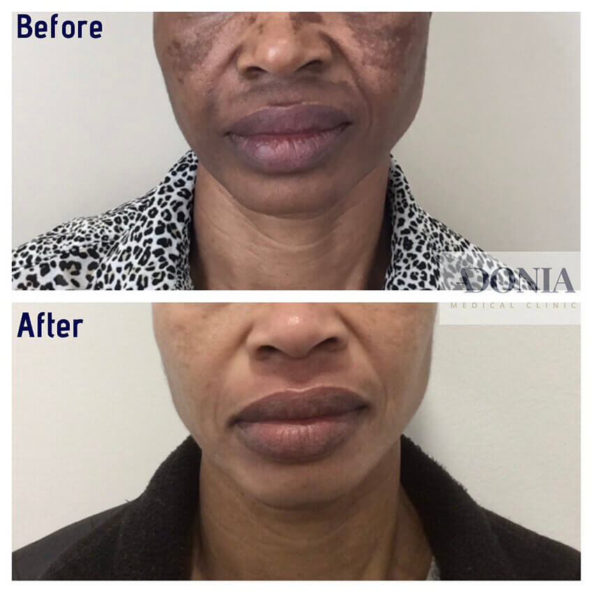 Female face, before and after Hyperpigmentation treatment, front view