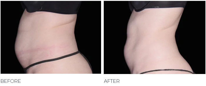 Female stomach Before And After EMSCULPT NEO treatment, l-side view, patient 2