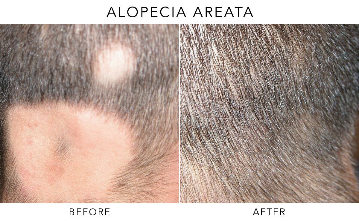 Alopecia Areata Before-After-A01