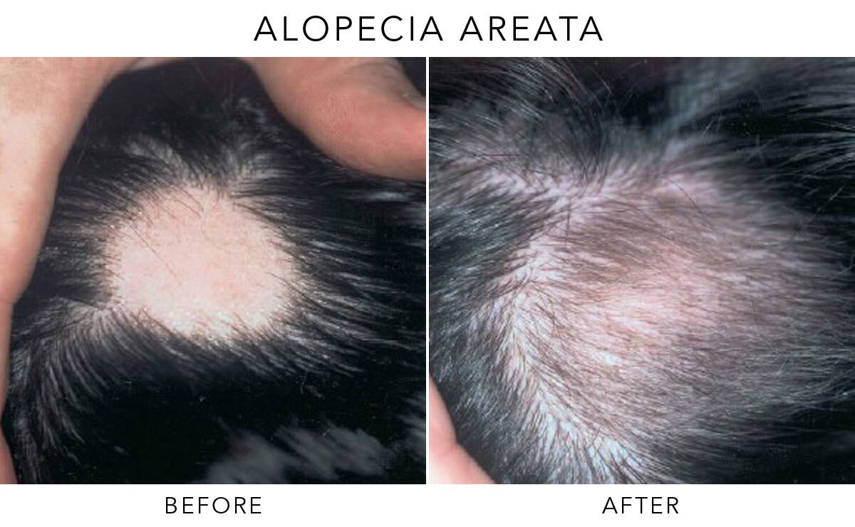Alopecia Areata Before-After-A02