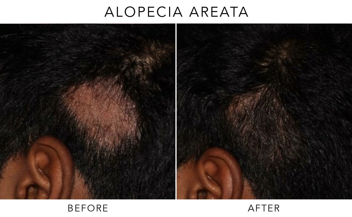 Alopecia Areata Before-After-A03