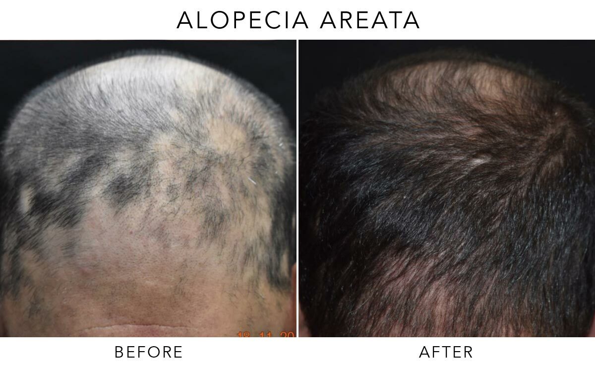 Alopecia Areata Before-After-A04