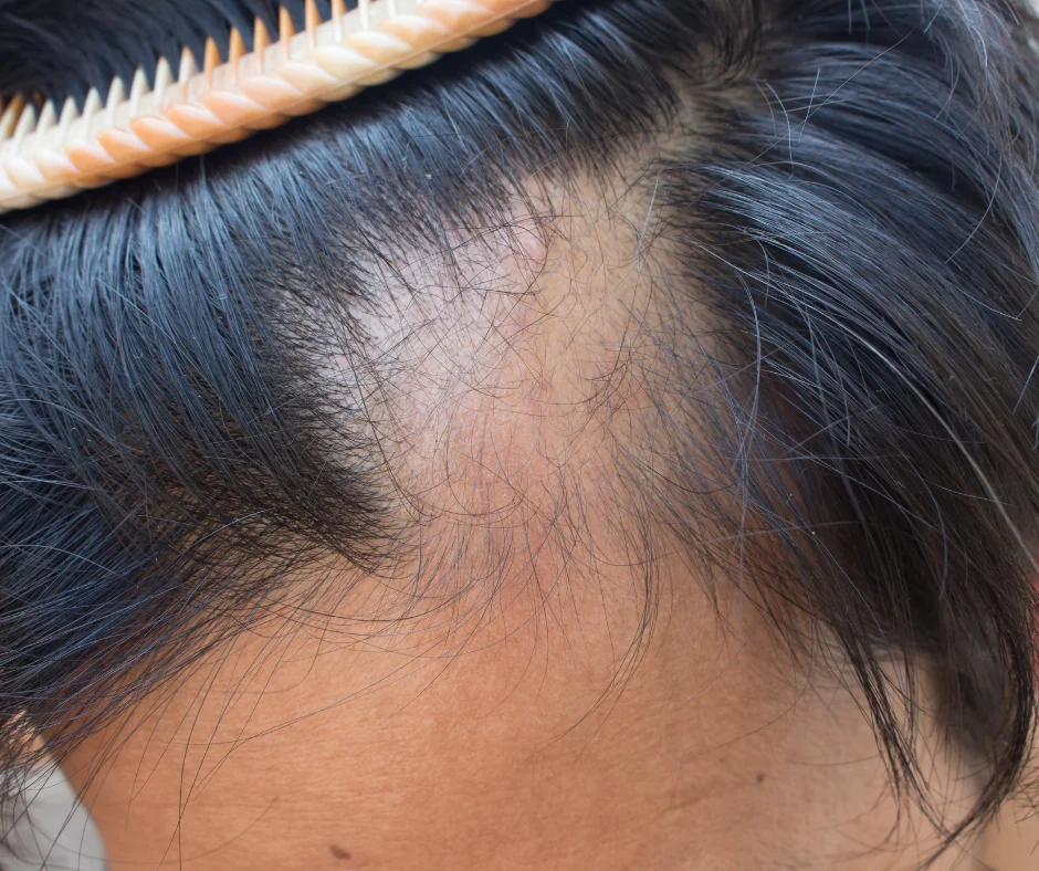 alopecia-areata-autoimmune-alopecia-areata