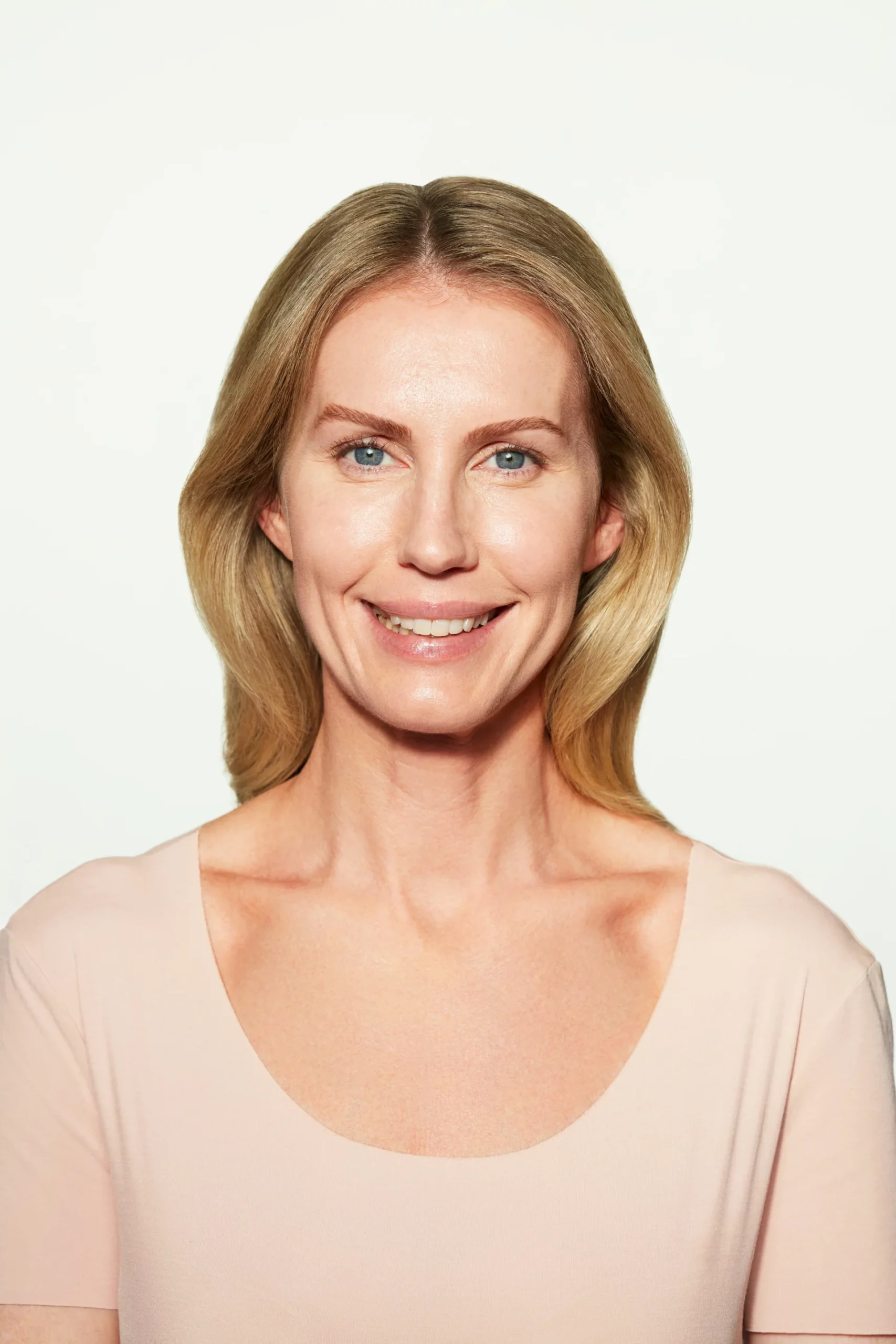 Sculptra Before and After - Chloe 6 Months After