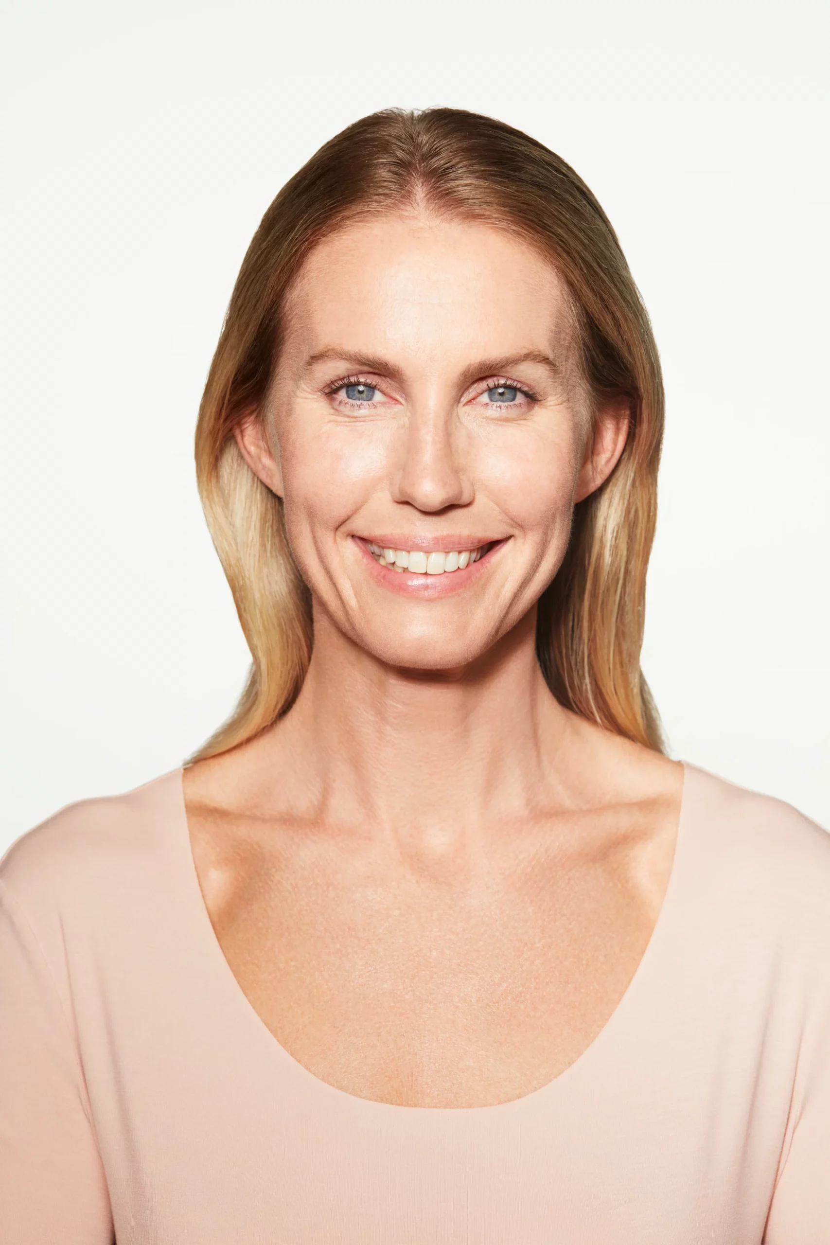 Sculptra Before and After - Chloe Before