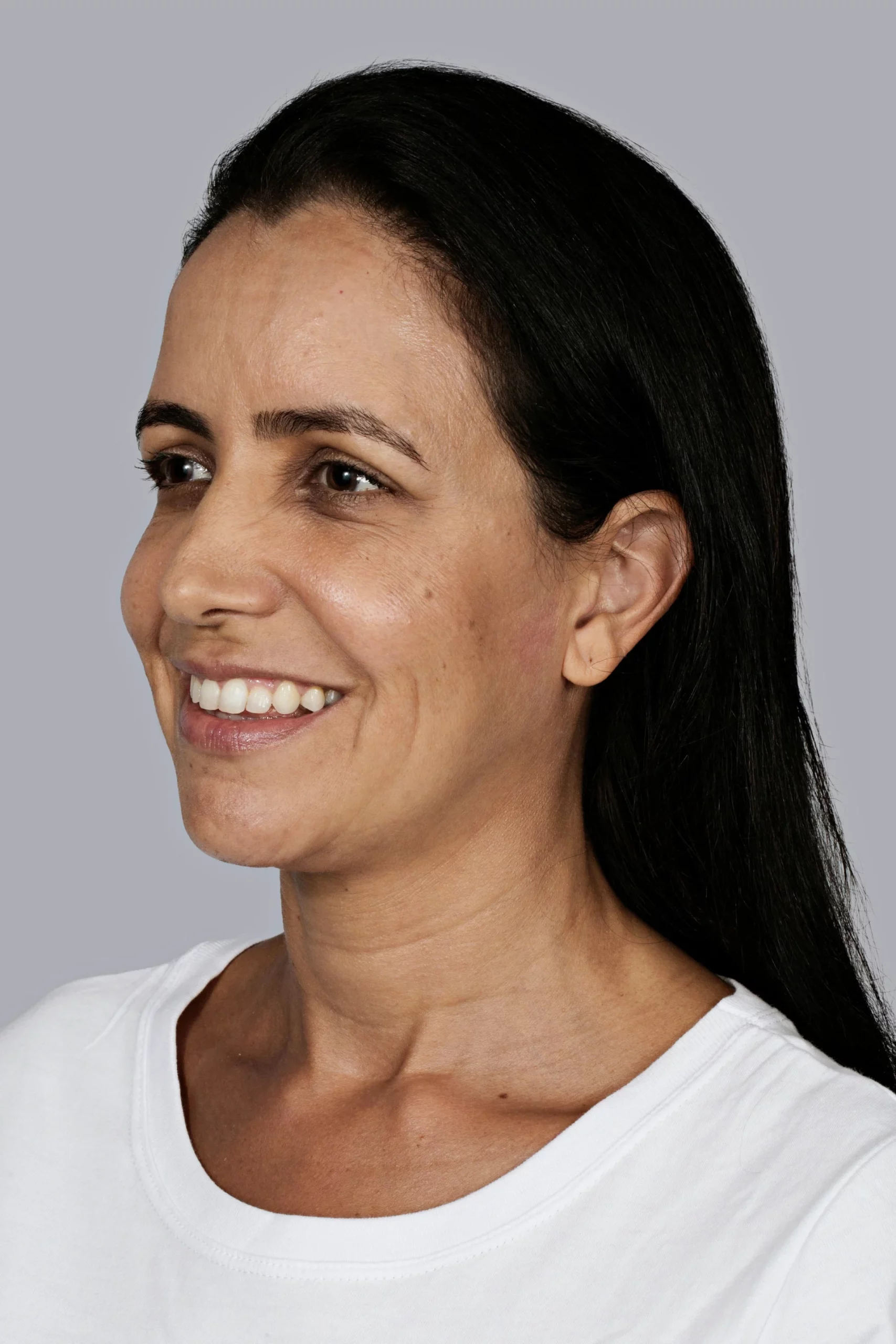 Sculptra Before and After - Mirna Before