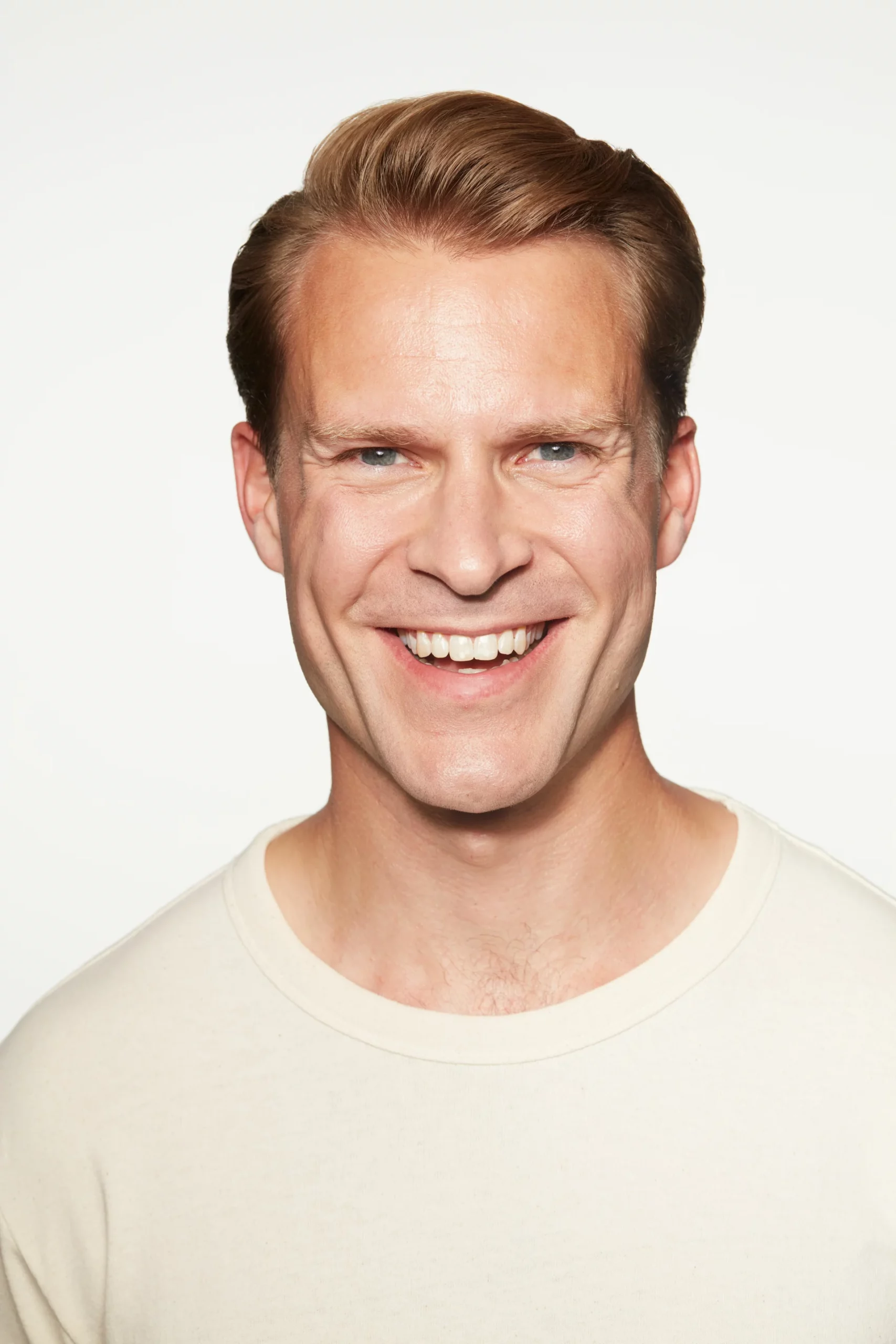 Sculptra Before and After - Rob Before
