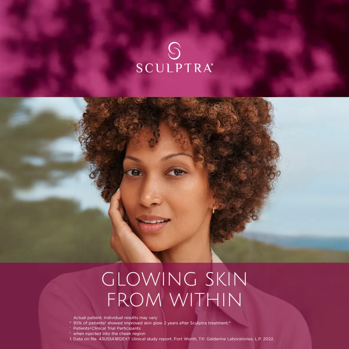 sculptra-sculptra-london-facial-rejuvenation-treatment
