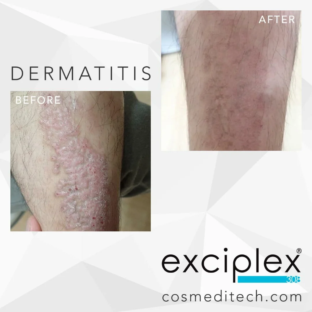 Atopic Dermatitis Before and After Results With Exciplex