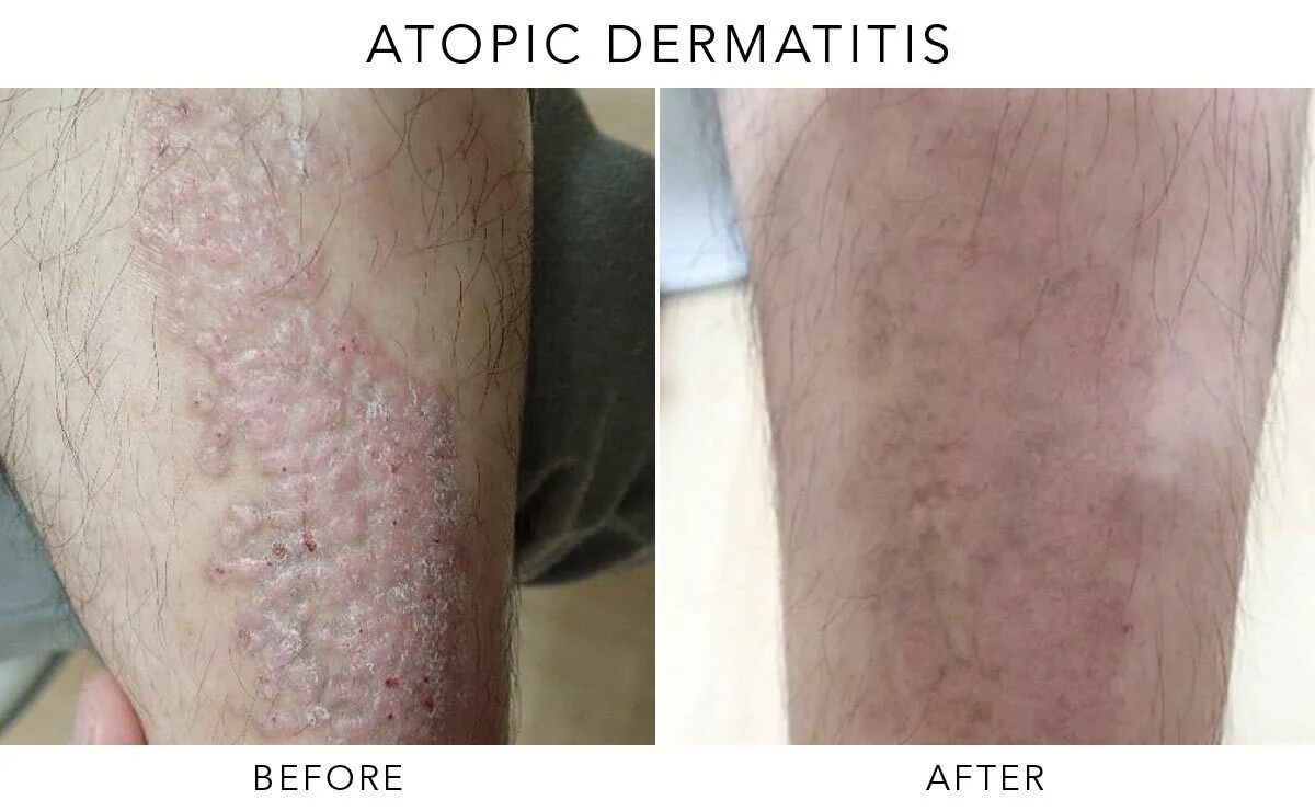 Atopic Dermatitis Exciplex Before and After Results
