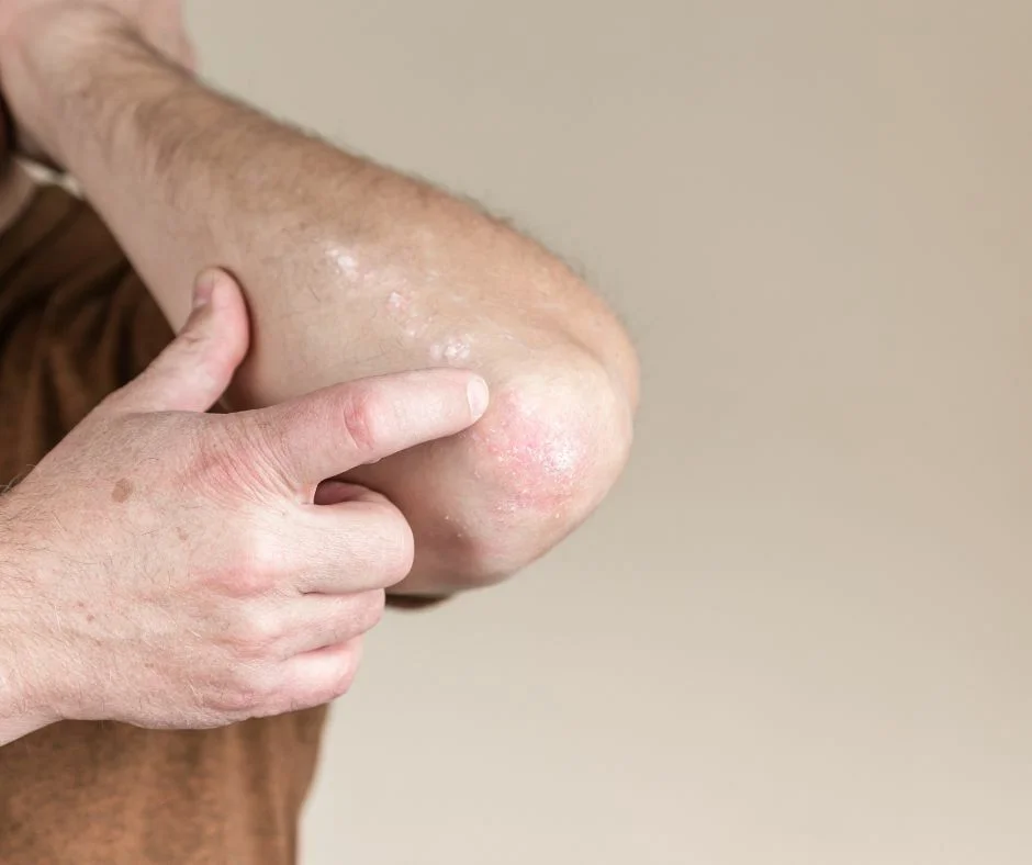 Atopic Dermatitis on the Elbow