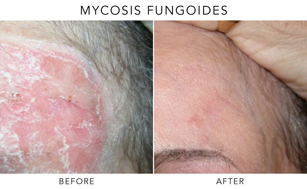 Mycosis Fungoides Before-After-M01